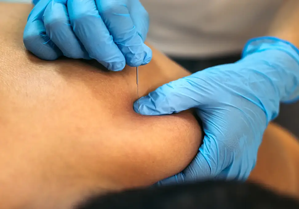 dry needling
